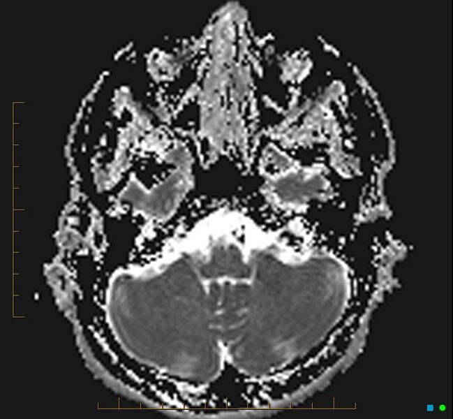 File:Cerebellar gangliocytoma (Radiopaedia 65377-74422 Axial ADC 8).jpg