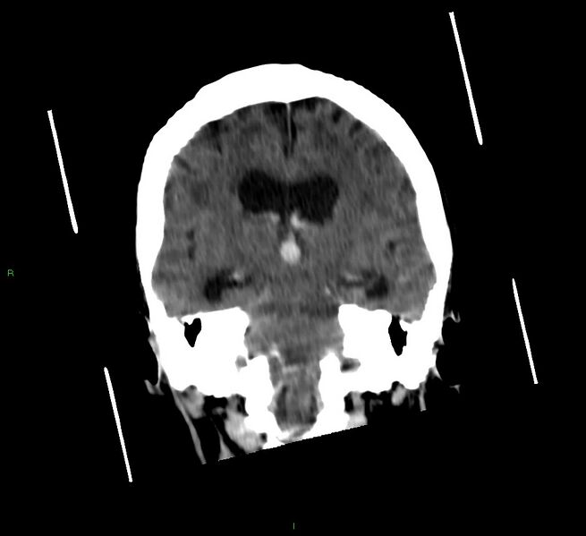 File:Cerebellar hemorrhage (Radiopaedia 58792-66026 Coronal non-contrast 32).jpg