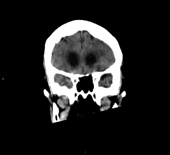 File:Cerebellar hemorrhage (Radiopaedia 58792-66026 Coronal non-contrast 45).jpg
