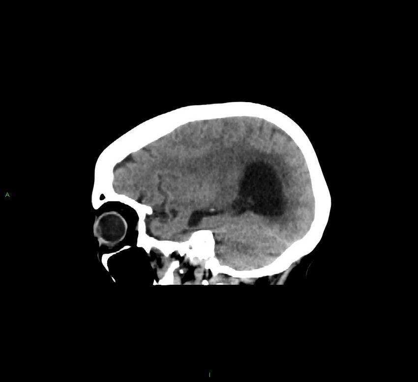 Cerebellar hemorrhage (Radiopaedia 58793-66027 C 37).jpg
