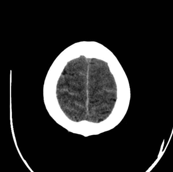 File:Cerebellar hemorrhage causing obstructive hydrocephalus (Radiopaedia 33989-35207 Axial non-contrast 46).jpg
