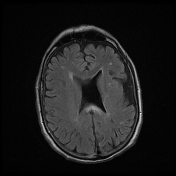 File:Cerebellar metastasis - lung tumor (Radiopaedia 69317-79147 Axial FLAIR 7).jpg