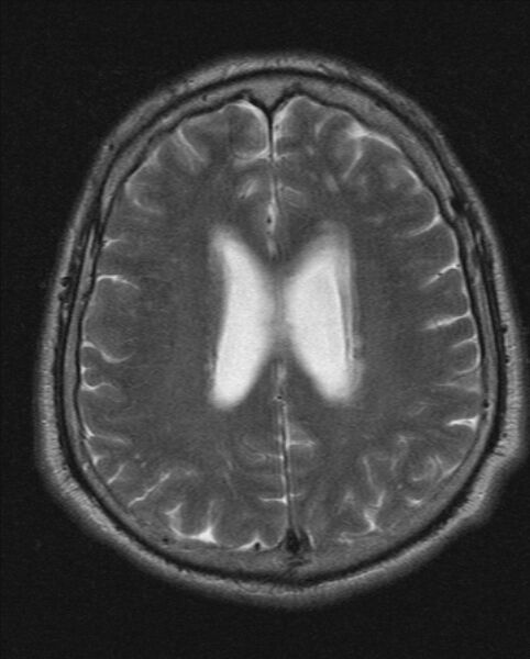 File:Cerebellopontine angle meningioma (Radiopaedia 24459-24764 Axial T2 16).jpg