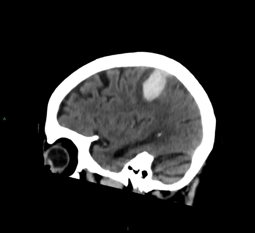 Cerebral amyloid angiopathy-associated lobar intracerebral hemorrhage (Radiopaedia 58376-65513 C 25).jpg