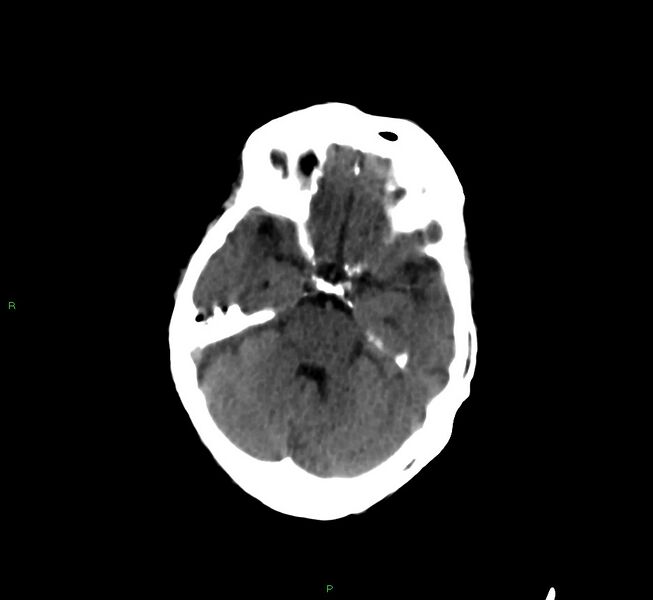 File:Cerebral amyloid angiopathy-associated lobar intracerebral hemorrhage (Radiopaedia 58377-65514 Axial non-contrast 34).jpg