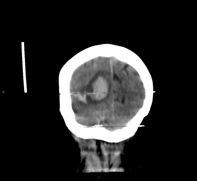 File:Cerebral amyloid angiopathy-associated lobar intracerebral hemorrhage (Radiopaedia 58377-65514 Coronal non-contrast 11).jpg
