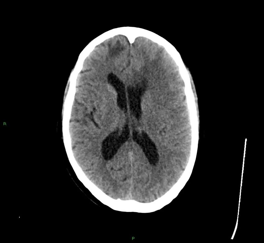 Cerebral amyloid angiopathy-associated lobar intracerebral hemorrhage (Radiopaedia 58529-65681 Axial non-contrast 24).jpg