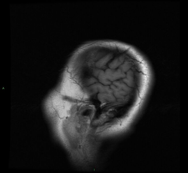 File:Cerebral amyloid angiopathy-associated lobar intracerebral hemorrhage (Radiopaedia 58529-65684 Sagittal T1 2).jpg