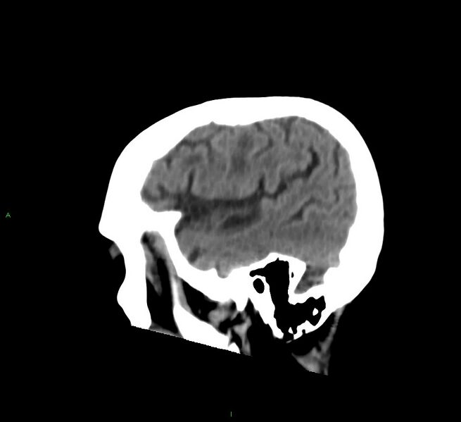 File:Cerebral amyloid angiopathy-associated lobar intracerebral hemorrhage (Radiopaedia 58530-65688 C 11).jpg