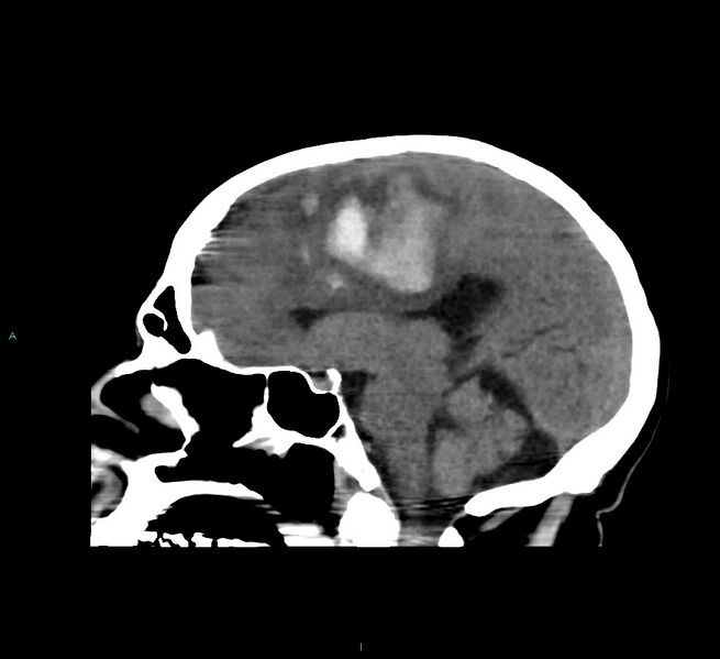 File:Cerebral amyloid angiopathy-associated lobar intracerebral hemorrhage (Radiopaedia 58560-65723 C 25).jpg