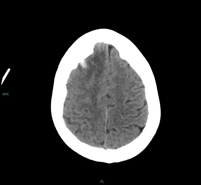 File:Cerebral amyloid angiopathy-associated lobar intracerebral hemorrhage (Radiopaedia 58569-65734 Axial non-contrast 19).jpg