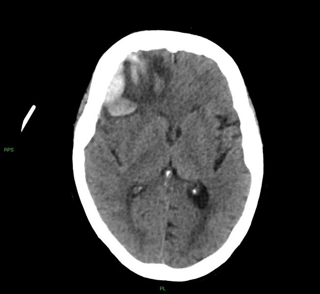 File:Cerebral amyloid angiopathy-associated lobar intracerebral hemorrhage (Radiopaedia 58569-65734 Axial non-contrast 33).jpg
