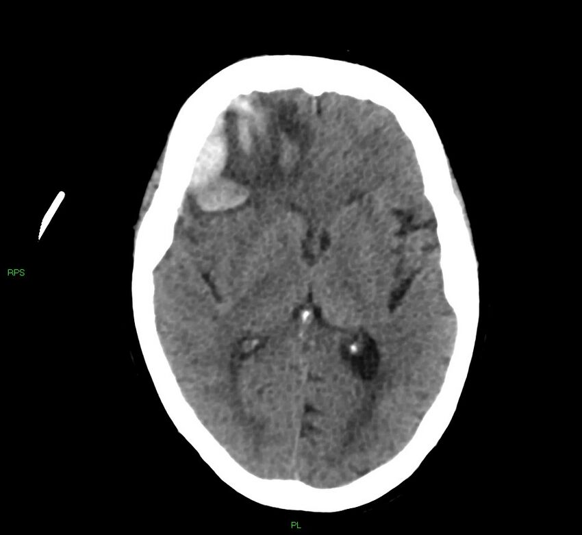Cerebral amyloid angiopathy-associated lobar intracerebral hemorrhage (Radiopaedia 58569-65734 Axial non-contrast 33).jpg