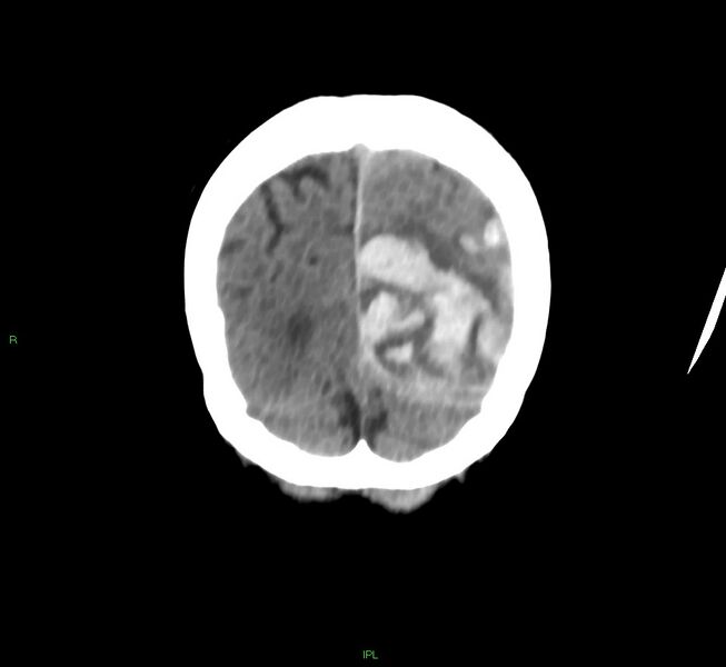 File:Cerebral amyloid angiopathy-associated lobar intracerebral hemorrhage (Radiopaedia 58754-65975 Coronal non-contrast 12).jpg