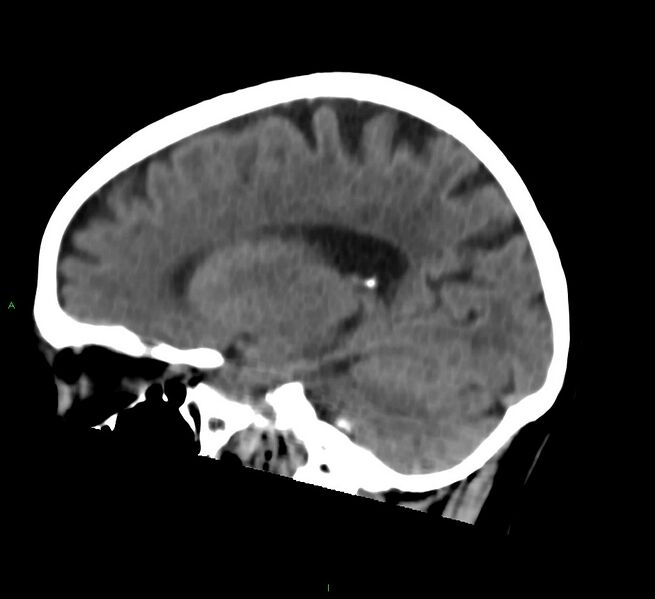 File:Cerebral amyloid angiopathy-associated lobar intracerebral hemorrhage (Radiopaedia 58757-65978 C 22).jpg