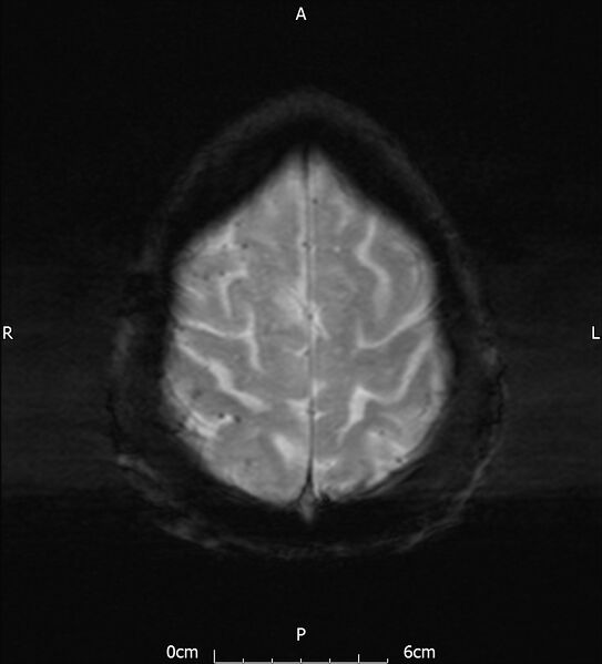 File:Cerebral amyloid angiopathy related inflammation (Radiopaedia 72772-83415 Axial SWI 20).jpg