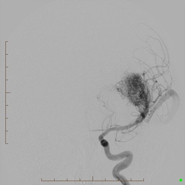 File:Cerebral arteriovenous malformation (AVM) (Radiopaedia 78162-90707 C 8).jpg