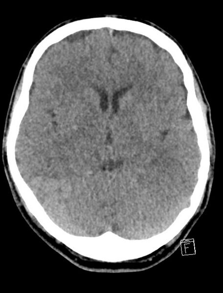 File:Cerebral arteriovenous malformation (Radiopaedia 78188-90745 Axial non-contrast 11).jpg