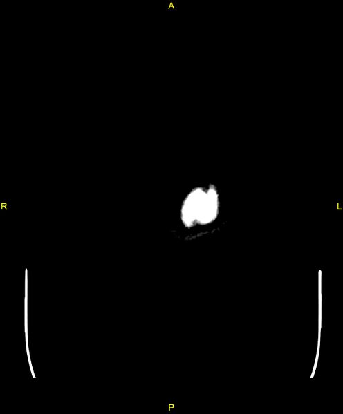File:Cerebral autosomal dominant arteriopathy with subcortical infarcts and leukoencephalopathy (CADASIL) (Radiopaedia 86108-102051 Axial non-contrast 123).jpg