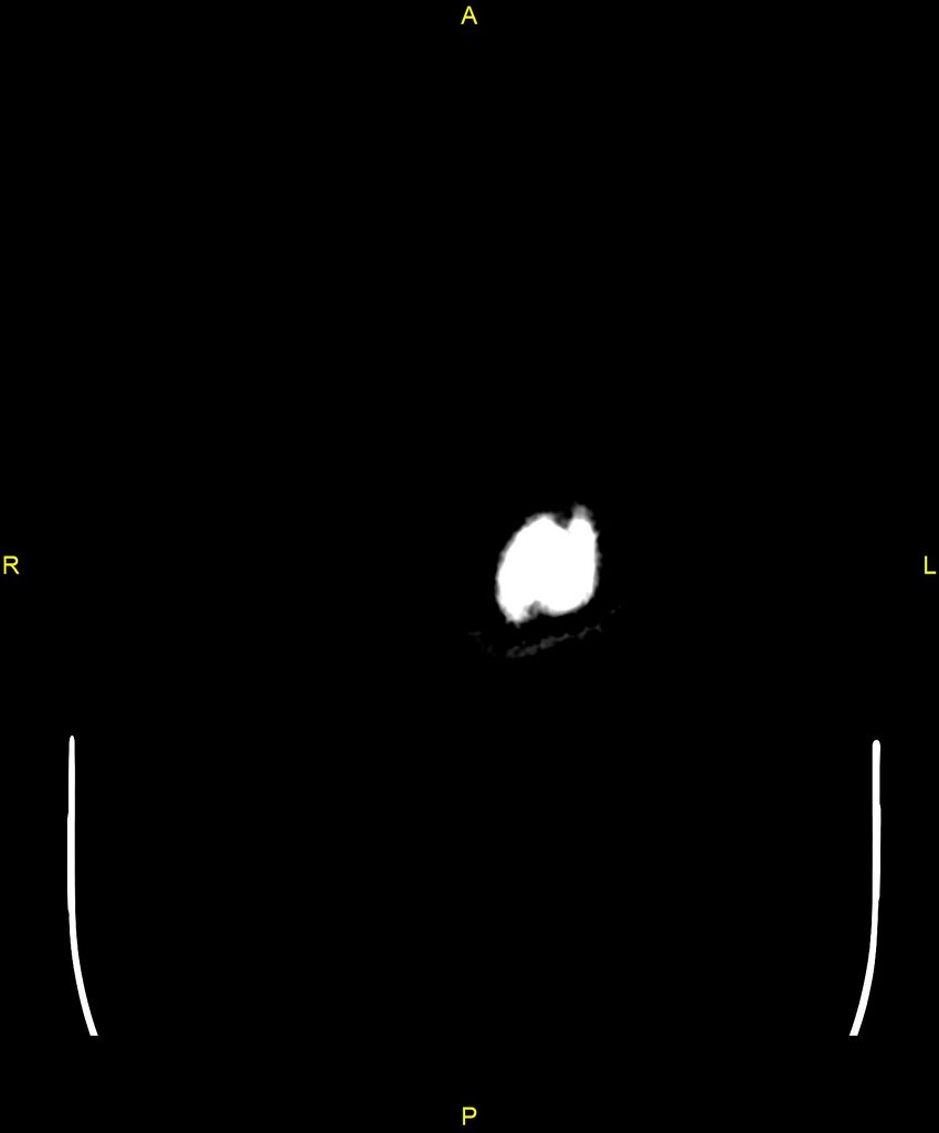 Cerebral autosomal dominant arteriopathy with subcortical infarcts and leukoencephalopathy (CADASIL) (Radiopaedia 86108-102051 Axial non-contrast 123).jpg