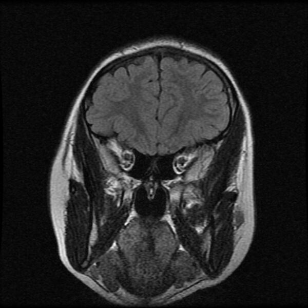 File:Cerebral cavernous malformation (Radiopaedia 44301-47942 Coronal FLAIR 1).jpg