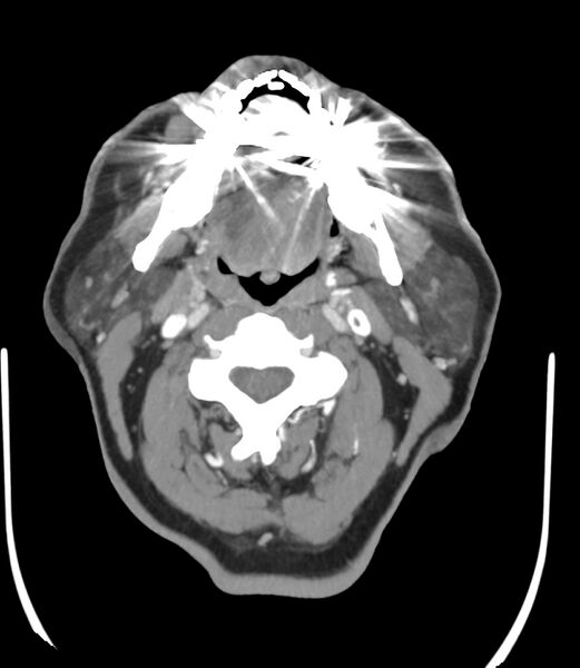 File:Cerebral dural venous sinus thrombosis (Radiopaedia 86514-102576 A 5).jpg
