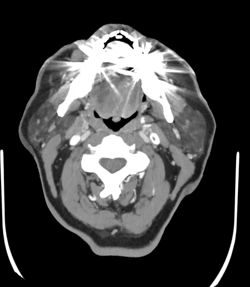 Cerebral dural venous sinus thrombosis (Radiopaedia 86514-102576 A 5).jpg