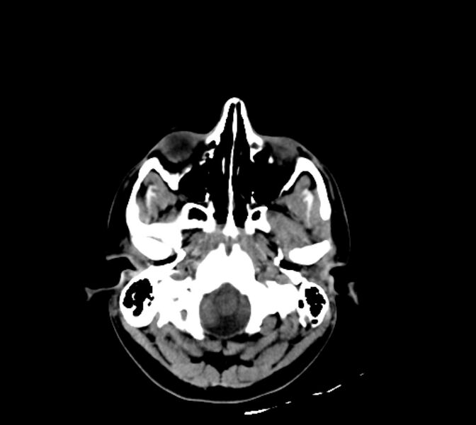 File:Cerebral fat embolism (Radiopaedia 37510-39362 Axial non-contrast 6).jpg