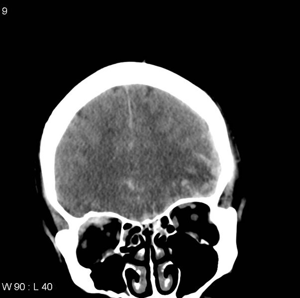 File:Cerebral hemorrhagic contusion with subdural and subarachnoid hemorrhage (Radiopaedia 10680-11146 Coronal non-contrast 5).jpg