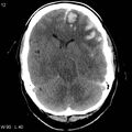 Cerebral hemorrhagic contusion with subdural and subarachnoid hemorrhage (Radiopaedia 10680-19197 Axial non-contrast 8).jpg