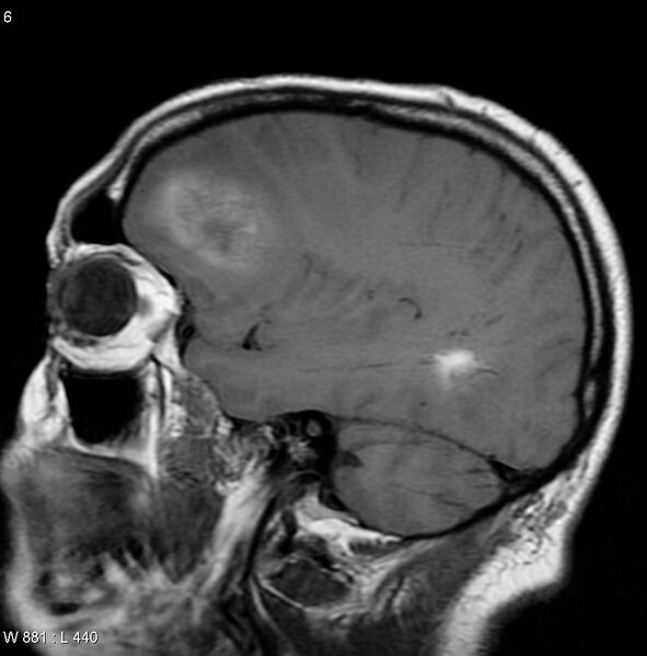 File:Cerebral metastases - renal cell carcinoma (Radiopaedia 5510-7246 Sagittal T1 2).jpg