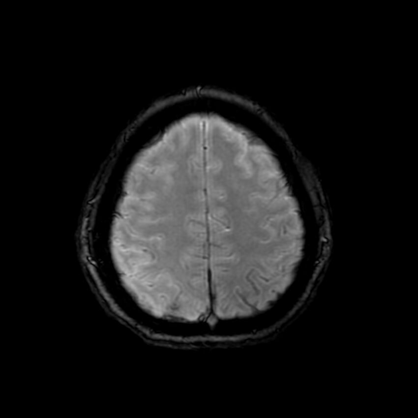 Cerebral paragonimiasis (Radiopaedia 73473-84238 Axial SWI 54).jpg