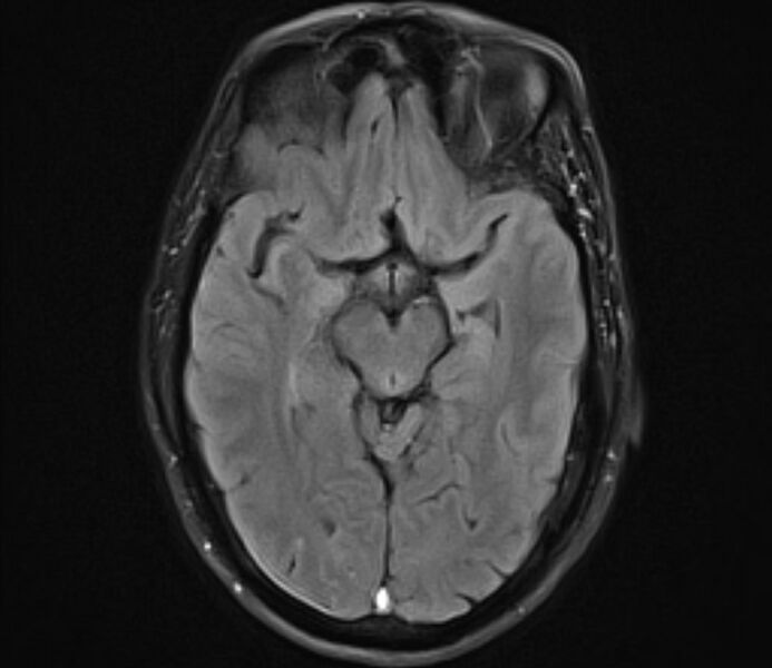 File:Cerebral venous thrombosis (Radiopaedia 71207-81504 Axial FLAIR 12).jpg