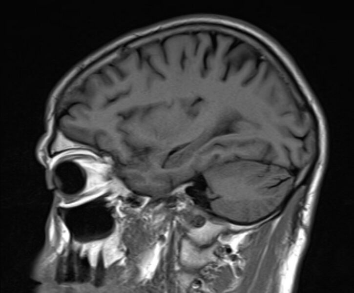 File:Cerebral venous thrombosis (Radiopaedia 71207-81504 Sagittal T1 8).jpg