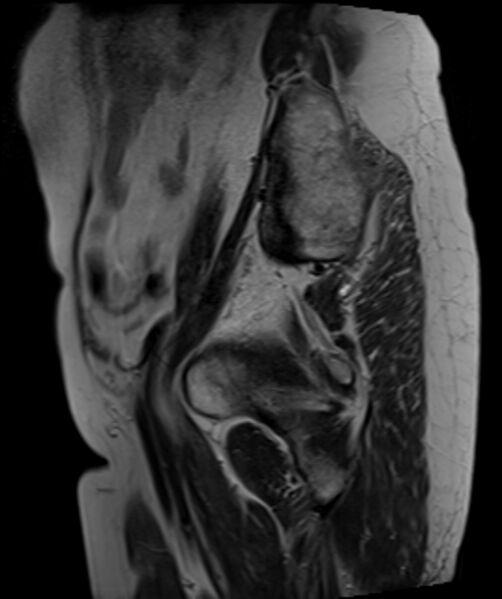 File:Cervical carcinoma (Radiopaedia 88312-104943 Sagittal T2 6).jpg