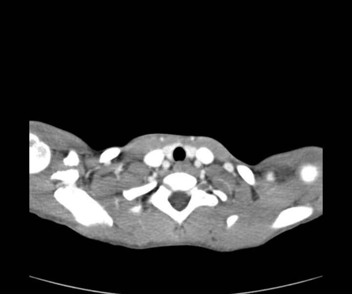 File:Cervical cystic lymphangioma (Radiopaedia 63655-72332 Axial + contrast 24).jpg