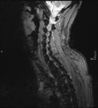 Cervical dural CSF leak on MRI and CT treated by blood patch (Radiopaedia 49748-54995 D 9).png