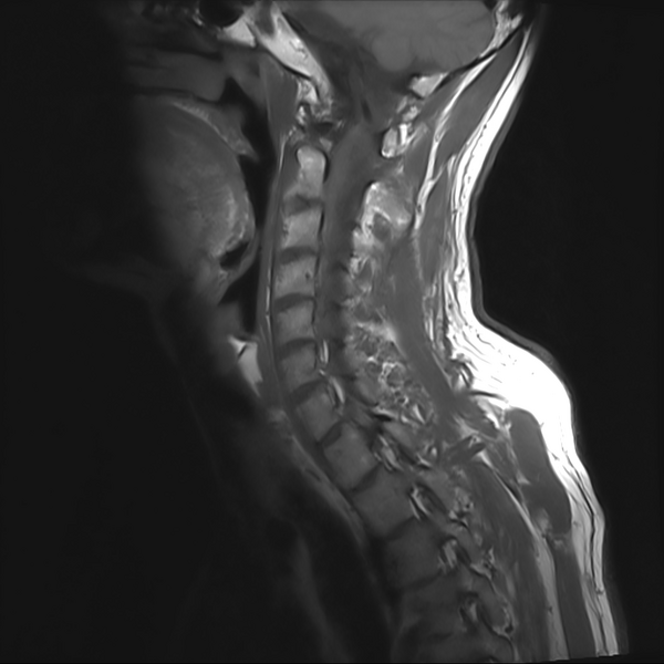 File:Cervical dural CSF leak on MRI and CT treated by blood patch (Radiopaedia 49748-54995 Sagittal T1 2).png