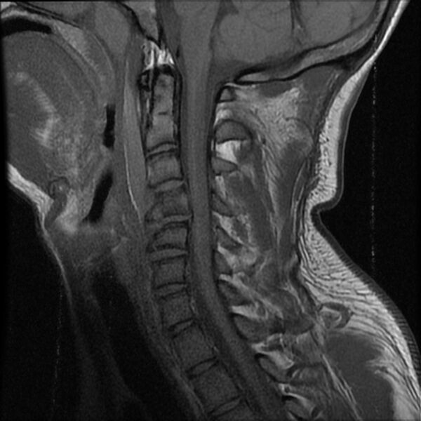 File:Cervical flexion teardrop fracture with cord hemorrhage (Radiopaedia 32497-33455 Sagittal T1 10).jpg