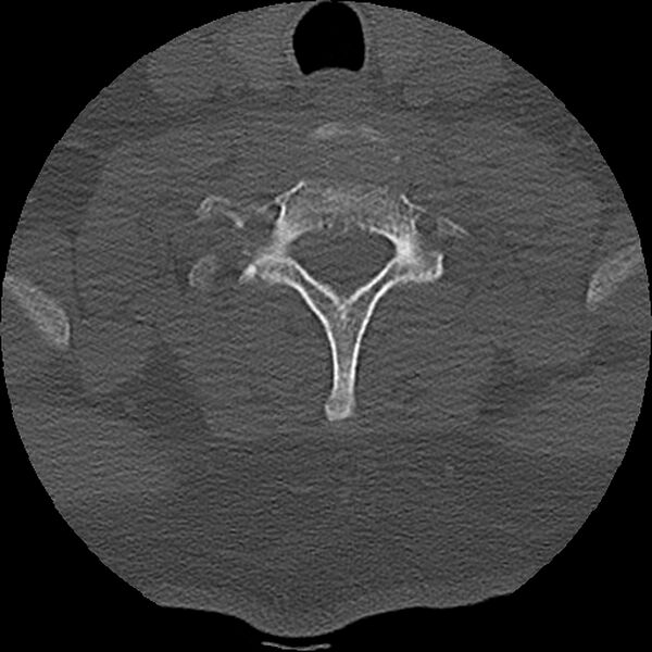File:Cervical fracture and dislocation with locked facet (Radiopaedia 31837-32780 Axial bone window 16).jpg