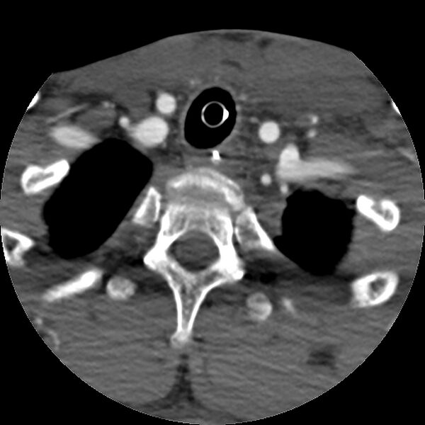 File:Cervical spine fractures with vertebral artery dissection (Radiopaedia 32135-33078 D 18).jpg