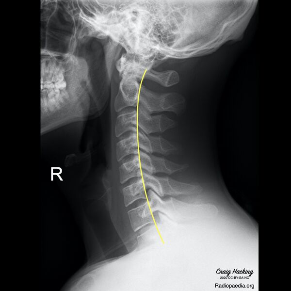 File:Cervical spine lines (Radiopaedia 76069-87571 E 1).jpeg