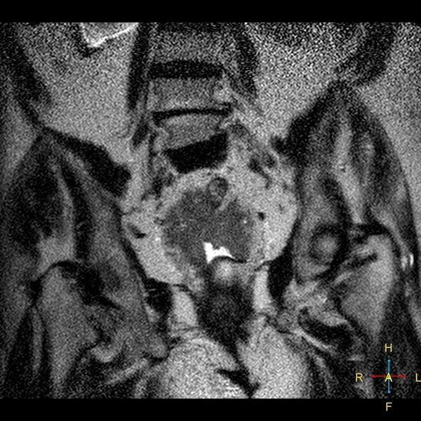File:Cervical stump squamous cell carcinoma (Radiopaedia 48049-52858 Coronal T2 10).jpg