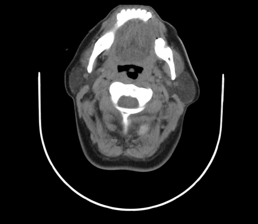 Cervical venous malformation (Radiopaedia 22653-22672 Axial non-contrast 23).jpg