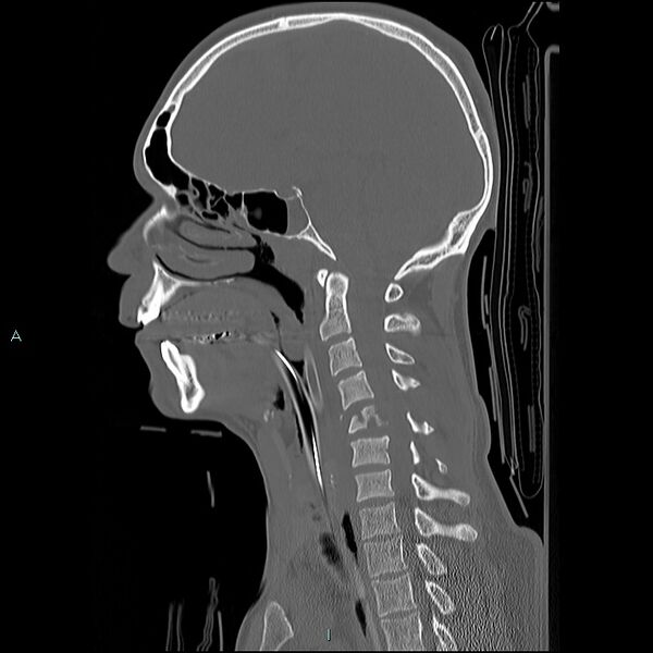 File:Cervical vertebral burst fracture (Radiopaedia 37420-39258 Sagittal bone window 13).jpg