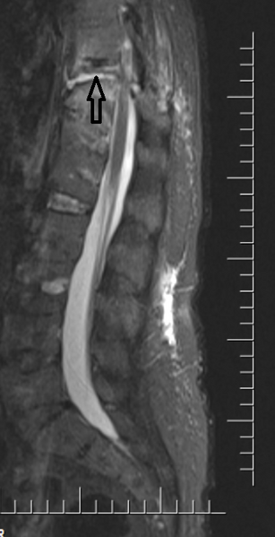 File:Chalk stick fracture - ankylosing spondylitis (Radiopaedia 52572-58485 Sagittal STIR 1).png