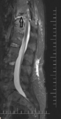 Chalk stick fracture - ankylosing spondylitis (Radiopaedia 52572-58485 Sagittal STIR 1).png