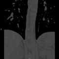 Chance fracture (Radiopaedia 36521-38081 Coronal bone window 2).jpg