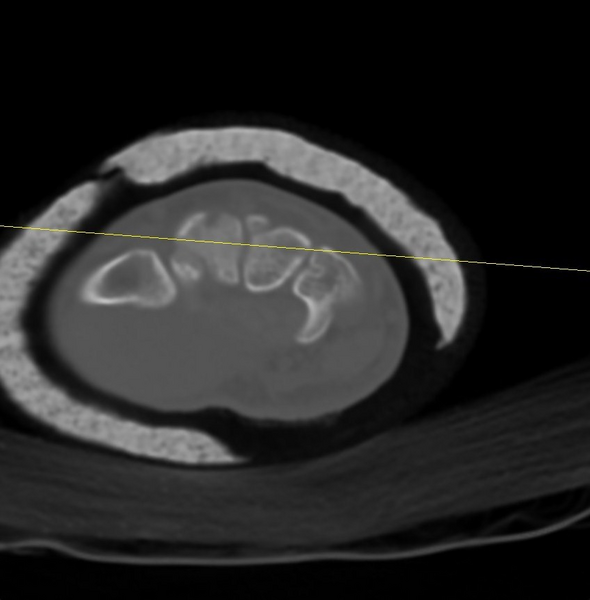 File:Chauffeur's (Hutchinson) fracture (Radiopaedia 58043-65079 Axial 19).png