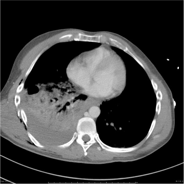 File:Chest and abdomen multi-trauma (Radiopaedia 26294-26426 bone window 3).jpg